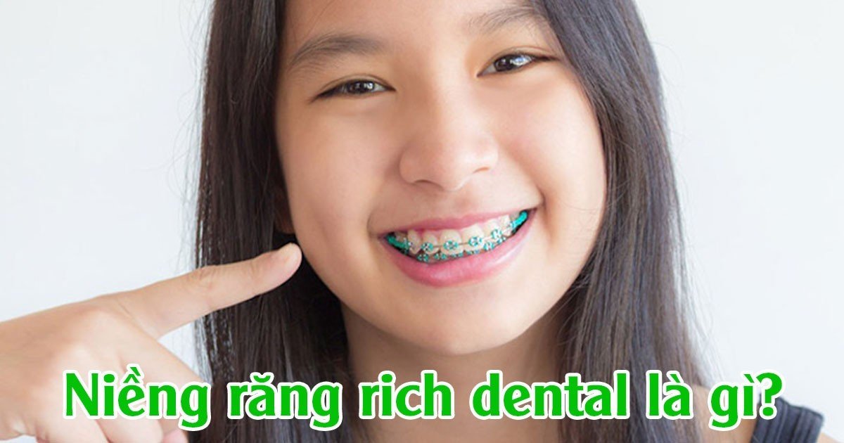 Niềng răng rich dental là gì?