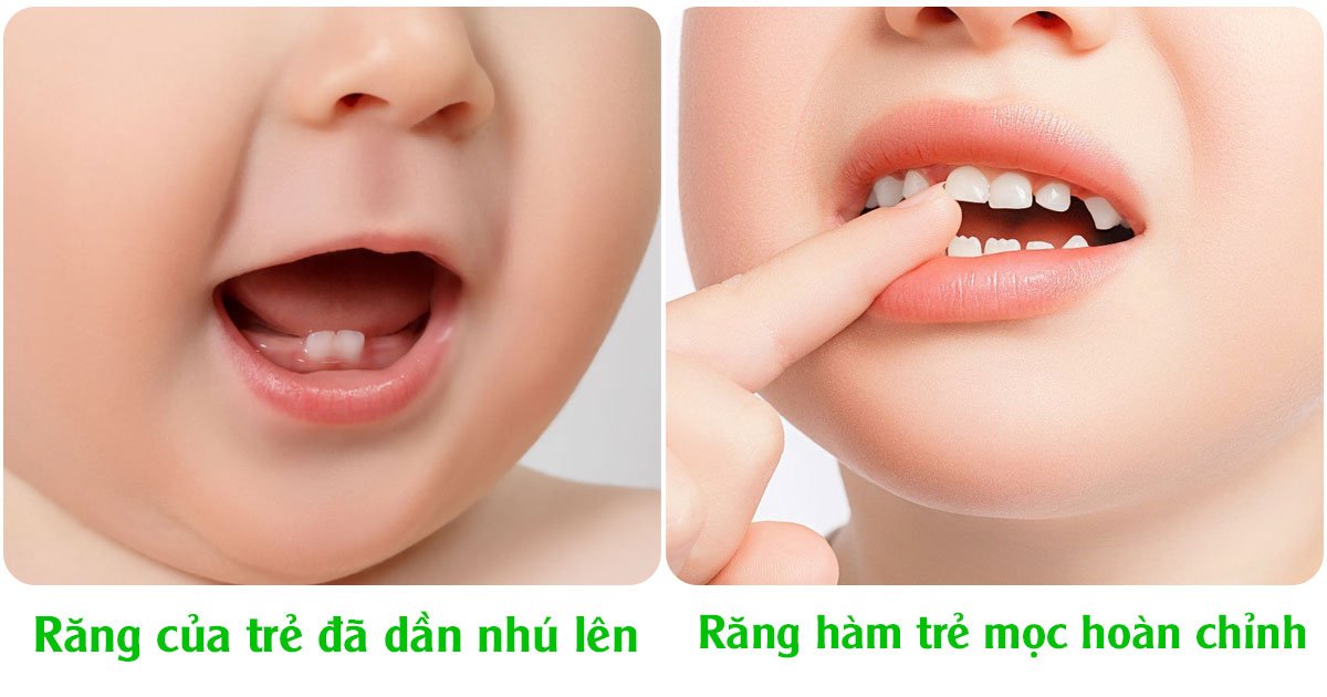 Răng trẻ dần nhủ lên và hoàn thiện