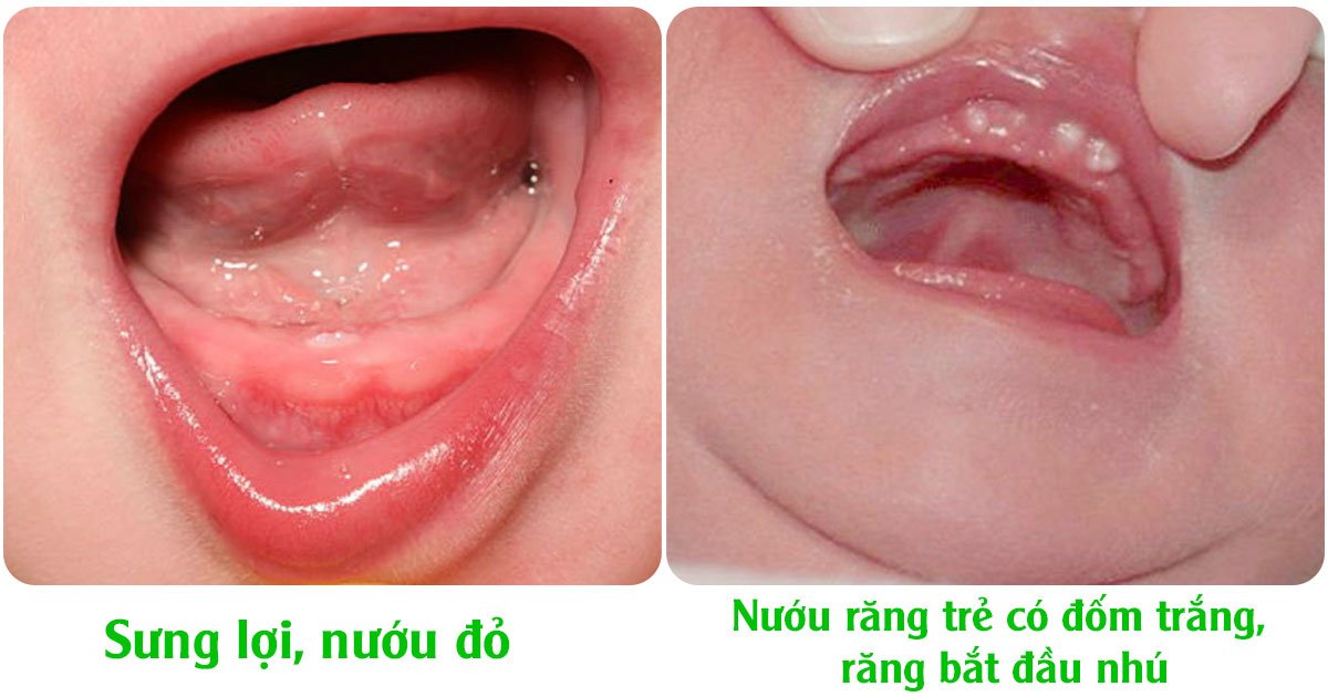 Trẻ có dấu hiệu sưng lợi, nướu đỏ và răng bắt đầu nhú lên