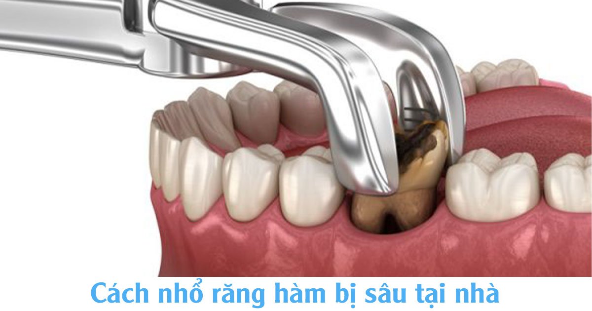 Cách nhổ răng hàm bị sâu tại nhà