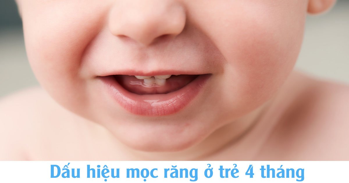 Dấu hiệu mọc răng ở trẻ 4 tháng