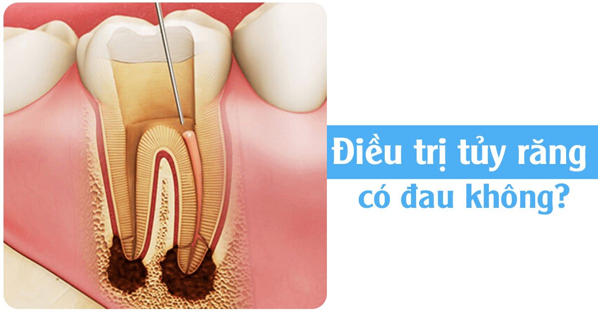 Điều trị tủy răng có đau không?
