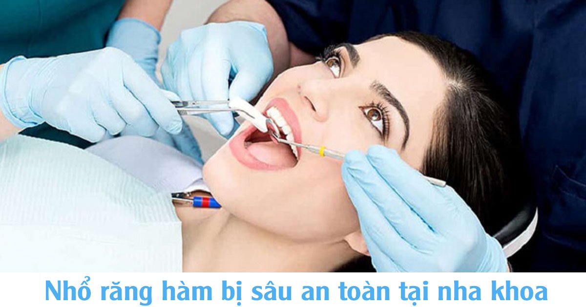 Nhổ răng hàm bị sâu an toàn tại nha khoa