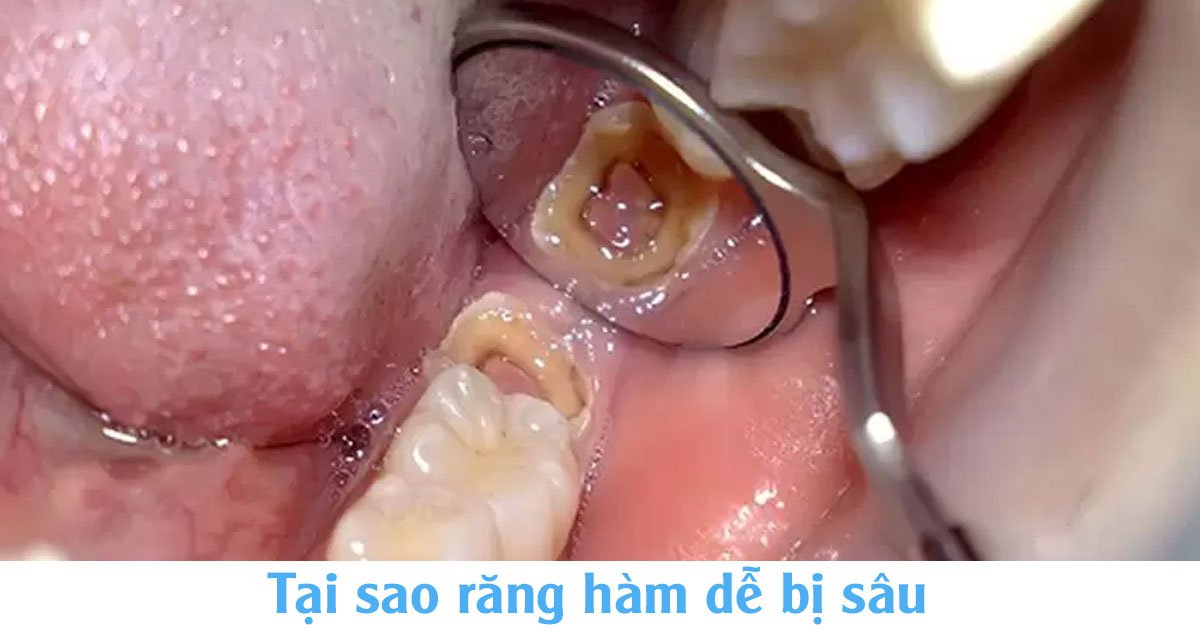 Tại sao răng hàm dễ bị sâu