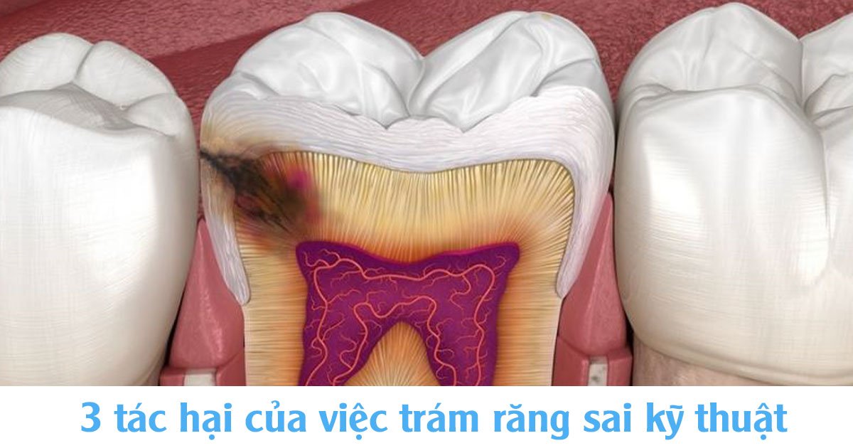 3 tác hại của việc trám răng sai kỹ thuật