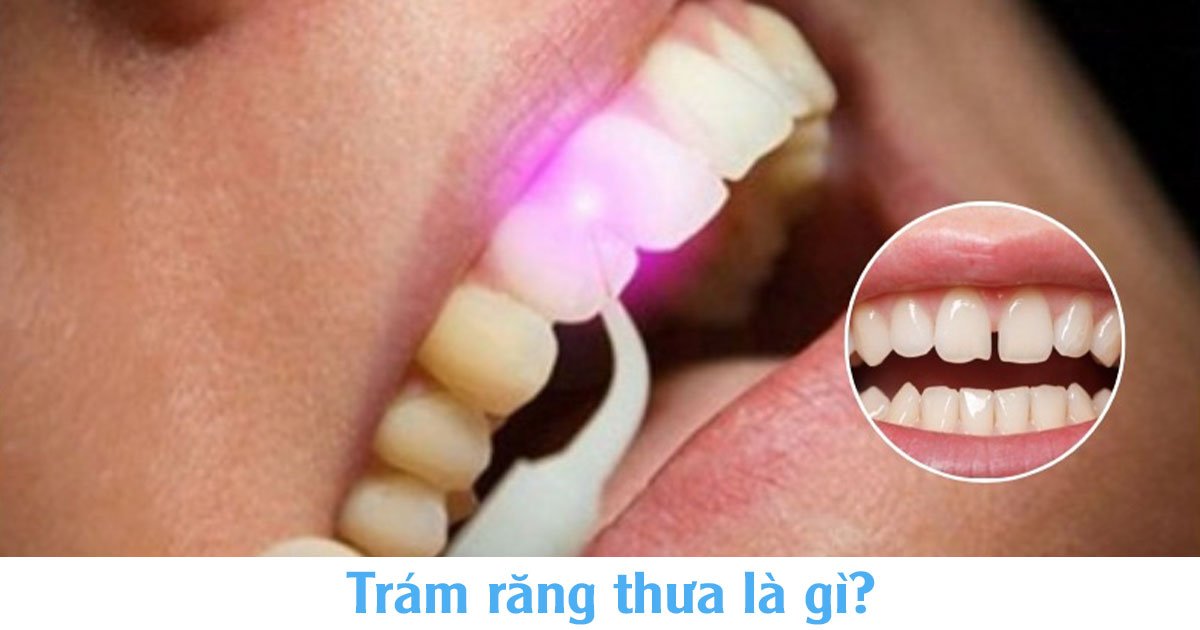 Trám răng thưa là gì?