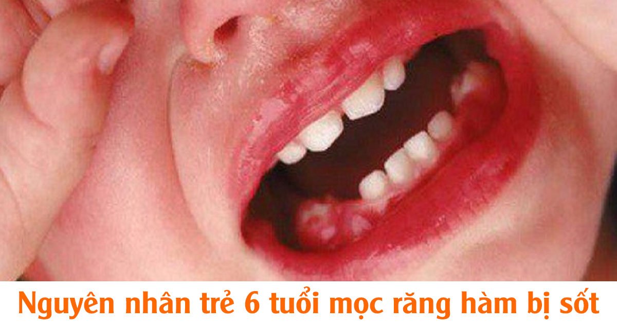 Nguyên nhân trẻ 6 tuổi mọc răng hàm bị sốt