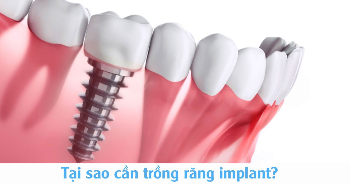 Tại sao cần trồng răng implant?
