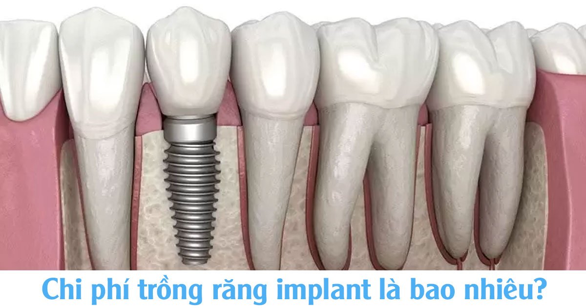 Chi phí trồng răng implant là bao nhiêu?