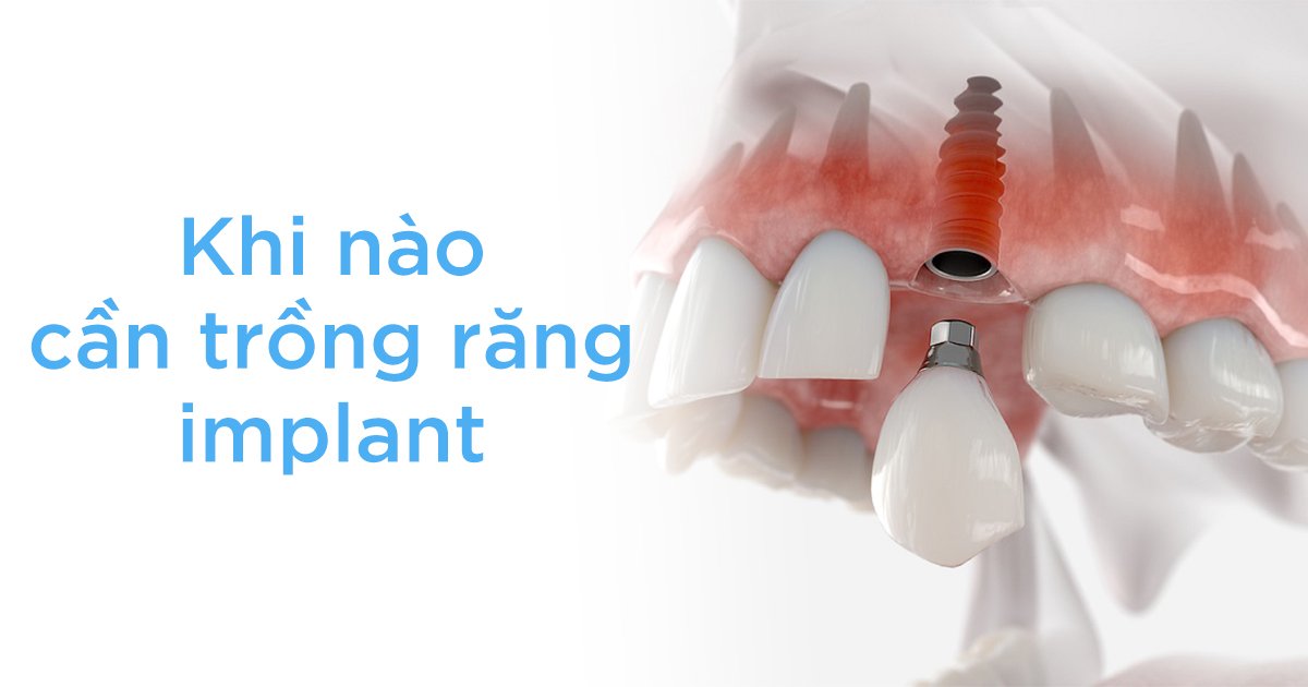 Khi nào cần trồng răng implant