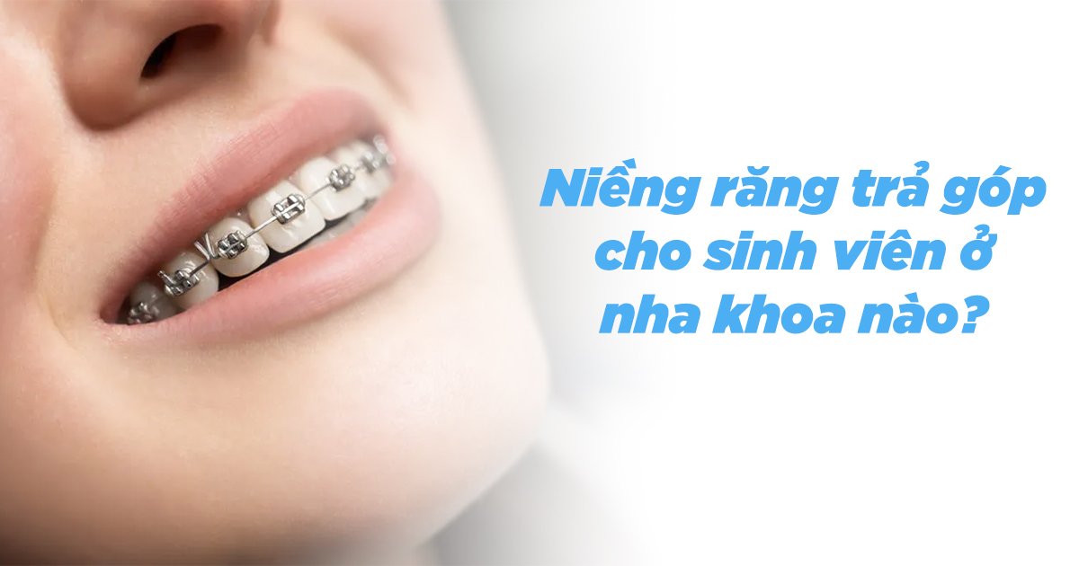 Niềng răng trả góp cho sinh viên ở nha khoa nào?