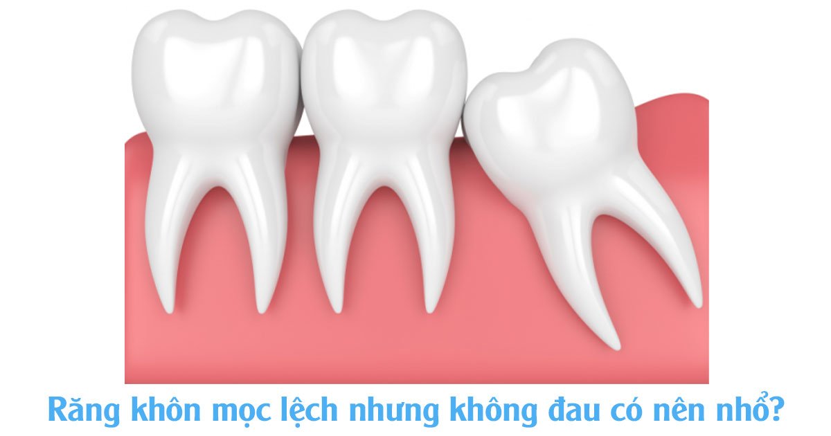 Răng khôn mọc lệch nhưng không đau có nên nhổ?