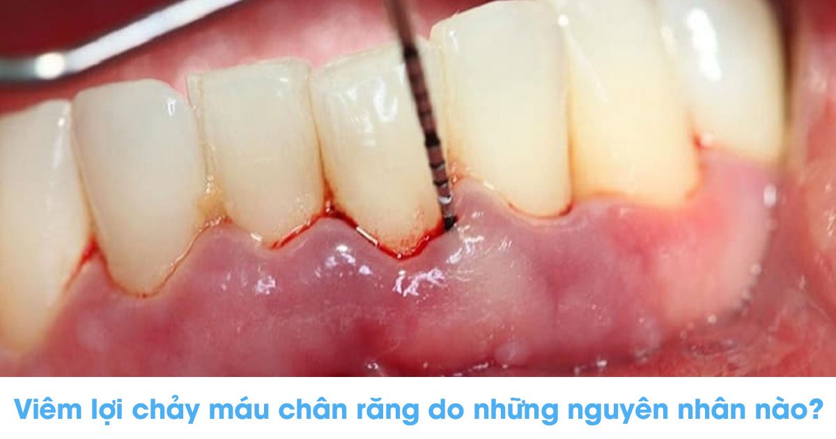 Viêm lợi chảy máu chân răng do những nguyên nhân nào?