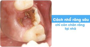 Cách nhổ răng sâu chỉ còn chân răng tại nhà