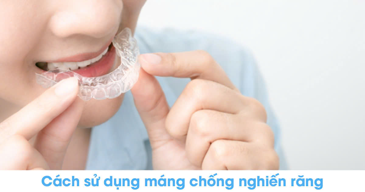 Cách sử dụng máng chống nghiến răng