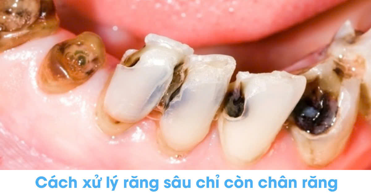 Cách xử lý răng sâu chỉ còn chân răng