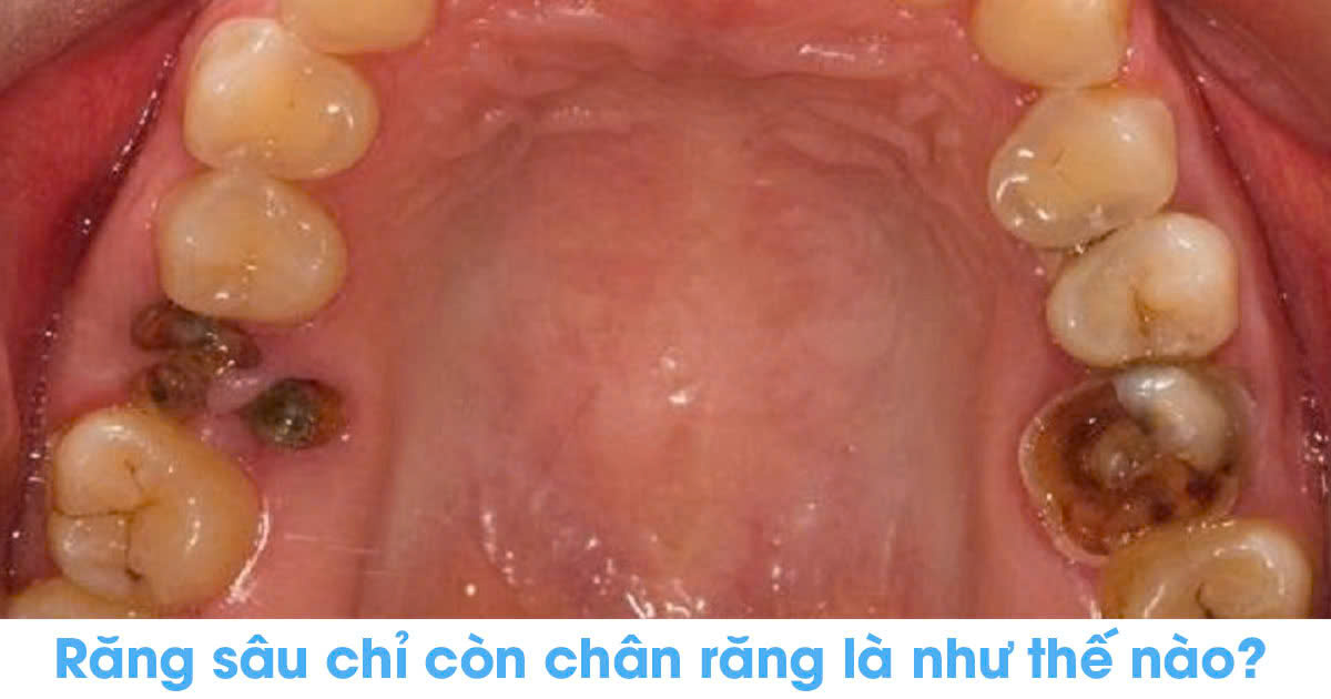 Răng sâu chỉ còn chân răng là như thế nào?