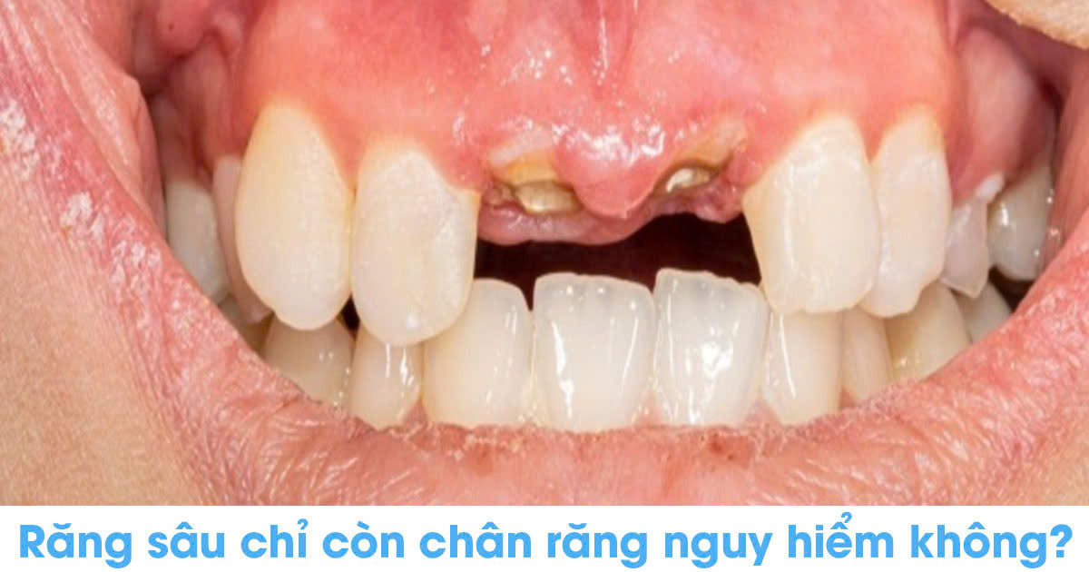 Răng sâu chỉ còn chân răng nguy hiểm không?