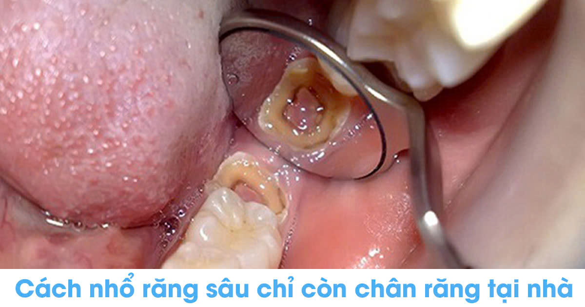 Cách nhổ răng sâu chỉ còn chân răng tại nhà