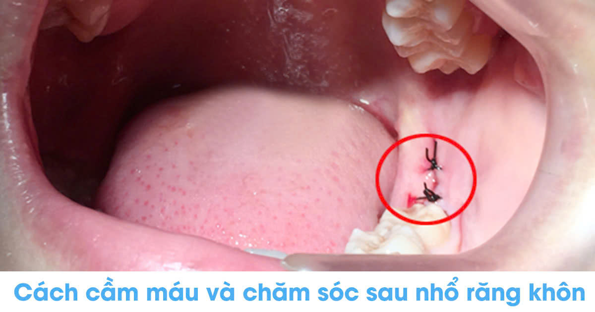 Cách cầm máu và chăm sóc sau nhổ răng khôn