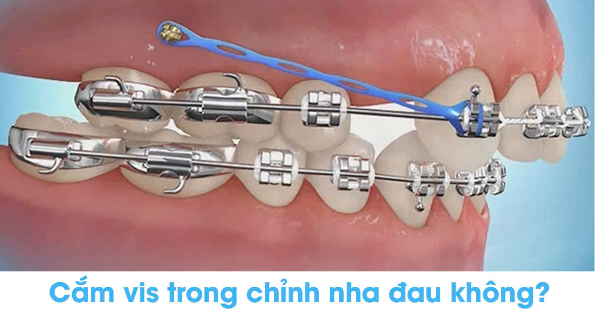 Cắm vis trong chỉnh nha đau không?