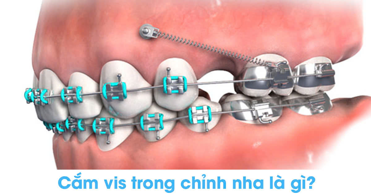 Cắm vis trong chỉnh nha là gì?