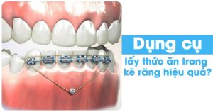 Dụng cụ lấy thức ăn trong kẽ răng hiệu quả?