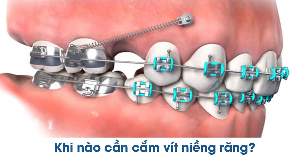 Khi nào cần cắm vít niềng răng?