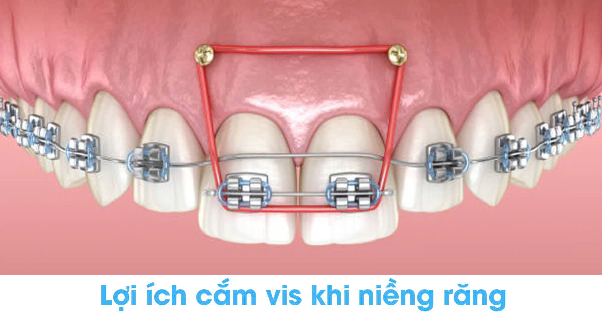 Lợi ích cắm vis khi niềng răng