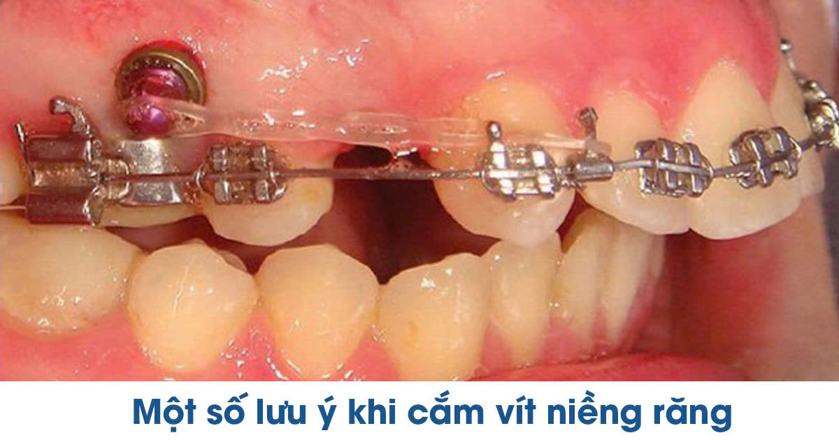 Một số lưu ý khi cắm vít niềng răng