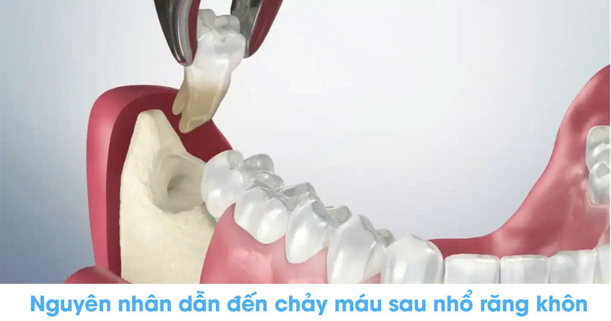 Nguyên nhân dẫn đến chảy máu sau nhổ răng khôn