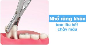 Nhổ răng khôn bao lâu hết chảy máu