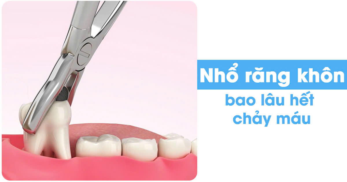 Nhổ răng khôn bao lâu hết chảy máu