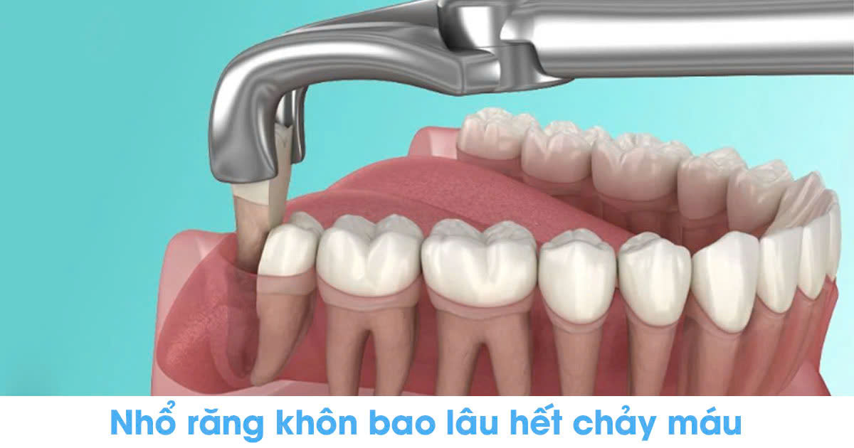 Nhổ răng khôn bao lâu hết chảy máu