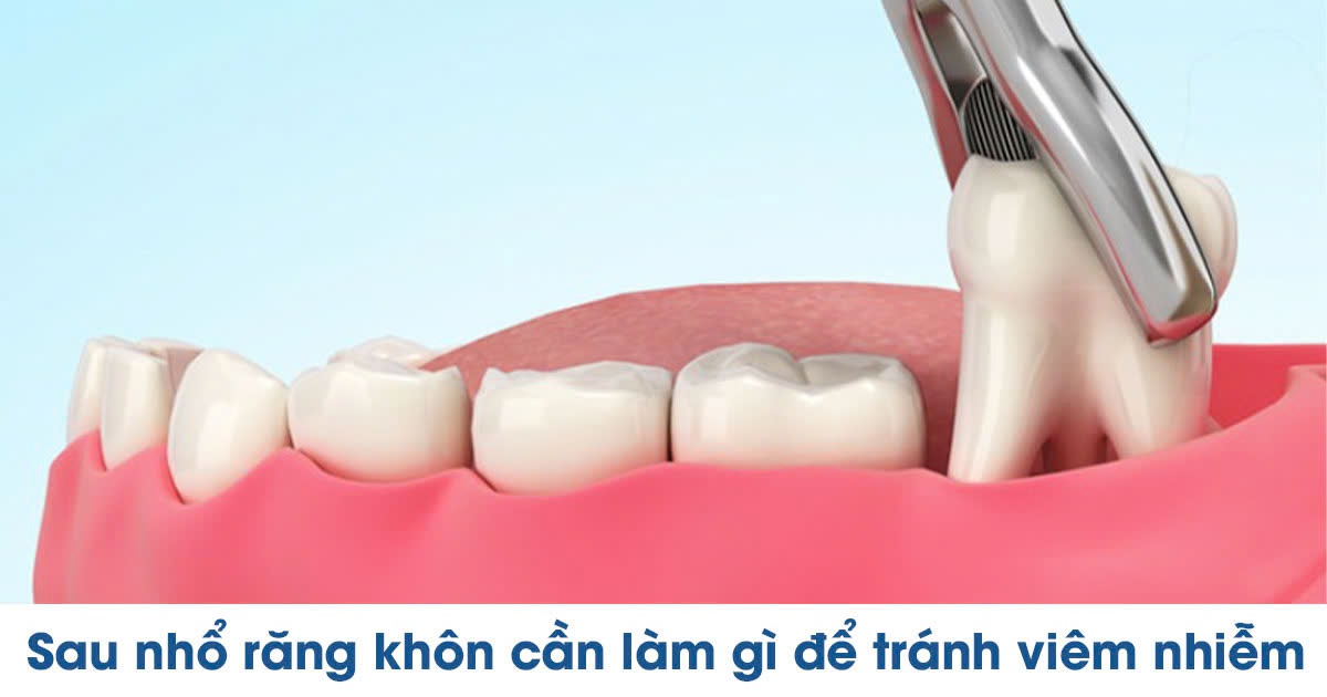 Sau nhổ răng khôn cần làm gì để tránh viêm nhiễm