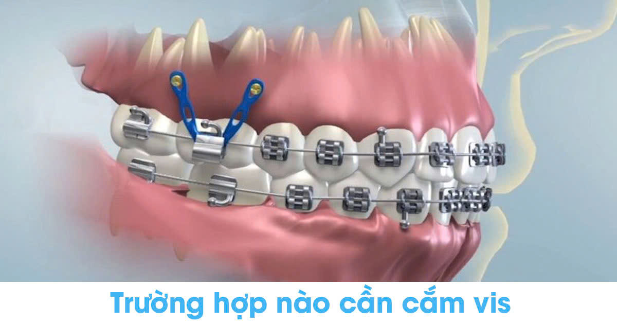 Trường hợp nào cần cắm vis