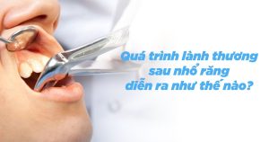 Quá trình lành thương sau nhổ răng diễn ra như thế nào?